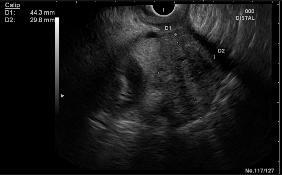 Endosonographisches Bild eines echoarm-inhomogenen Bauchspeicheldrüsentumors (in der Bildmitte mit Messpunkten); im oberen Bildanteil in der Mitte erkennt man den Schallkopf des Spiegelungsinstrumentes als weißen Halbkreis; dies verdeutlicht die enge La