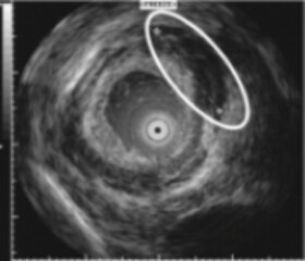 Speiseröhrenkrebs, der die gesamte Wand erfasst hat (Tumorstadium T3). Darstellung mit einer Minisonde.