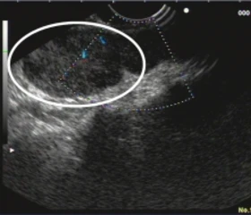 Neben der Speiseröhre gelegener Lymphknoten (Ellipse), welcher zur Gewebegewinnnung mit einer Nadel punktiert werden soll. Zuvor erfolgt mit der farbkodierten Duplexsonografie der Ausschluss größerer Blutgefäße im geplanten Punktionskanal um eine gef