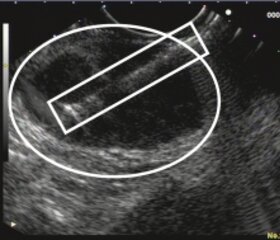 Eine Nadel (Kasten) wurde in den Lymphknoten (Ellipse) vorgeschoben; somit kann unter kontinuierlicher Sicht ein Gewebefragment gewonnen werden, welches dann zur weiteren Untersuchung an den Pathologen gegeben wird.