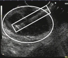 Eine Nadel (Kasten) wurde in den Lymphknoten (Ellipse) vorgeschoben; somit kann unter kontinuierlicher Sicht ein Gewebefragment gewonnen werden, welches dann zur weiteren Untersuchung an den Pathologen gegeben wird.